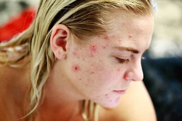 Acne Scar Treatment