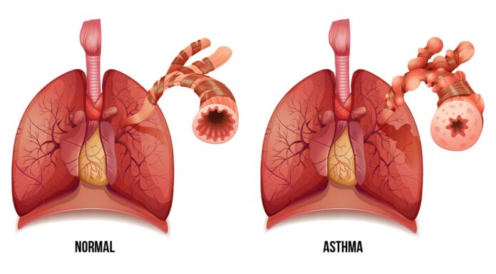 allergic asthma