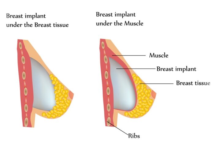 breast-augmentation-surgery