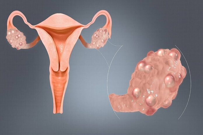 Causes of POCD and PCOS