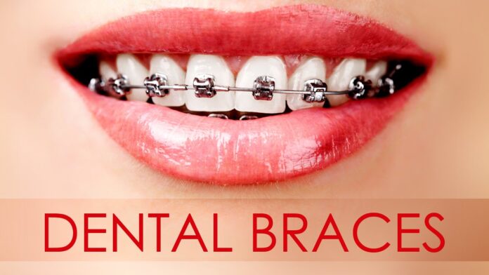 Dental Braces