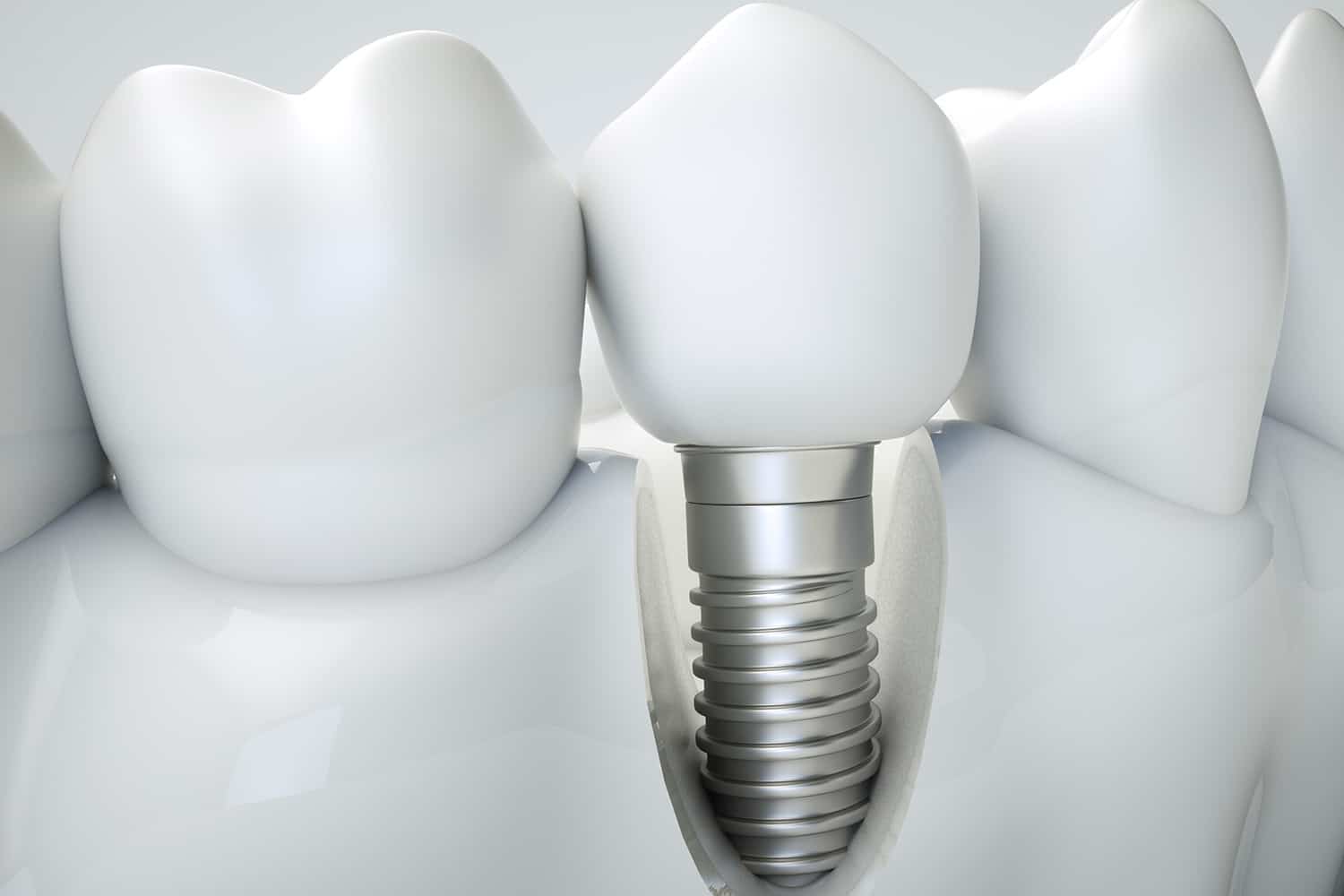 Dental Implants