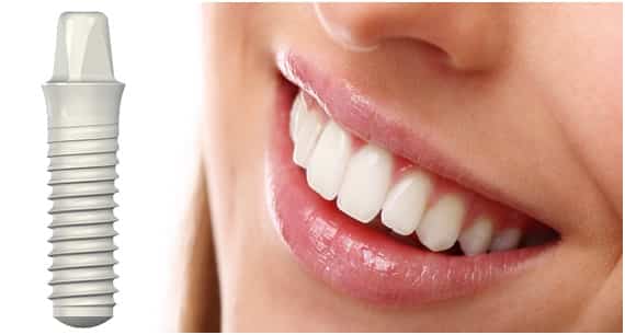 Dental Implants