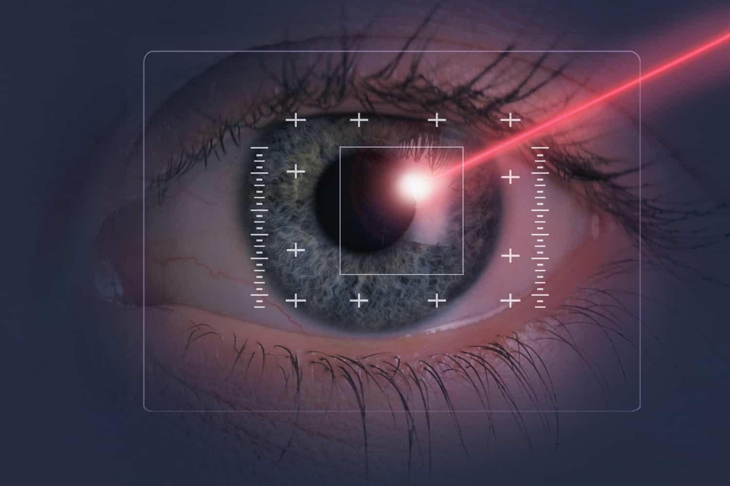 EPI Lasik Surgery