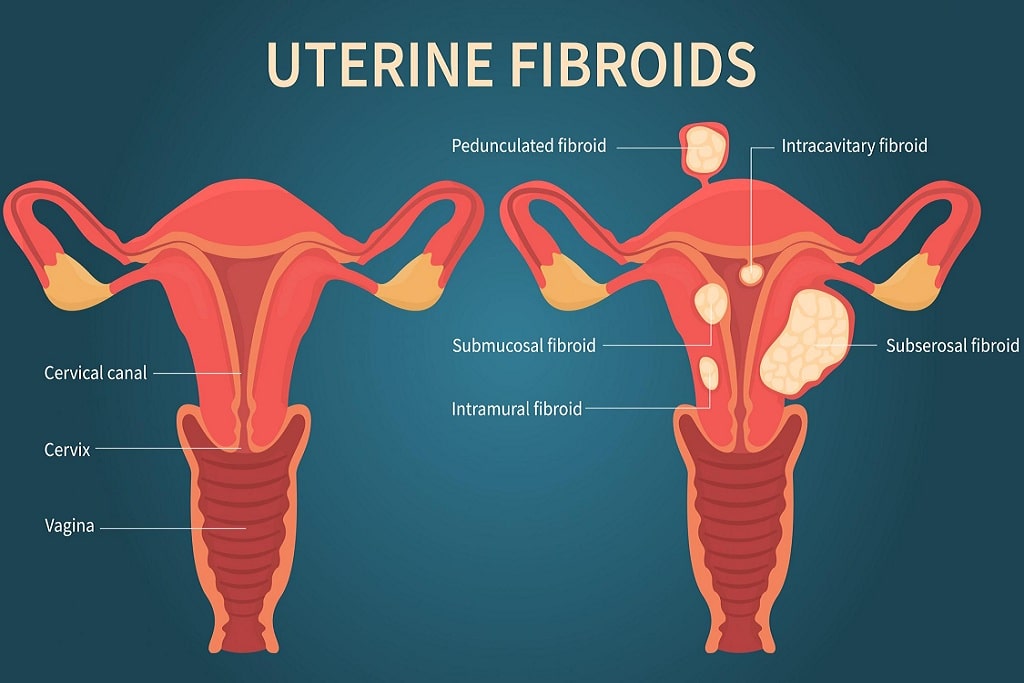 Natural Remedies for Fibroids